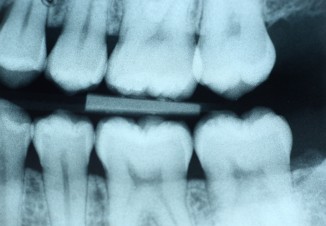 Dental x-ray (bite-wing) of the left side without any visible decay.